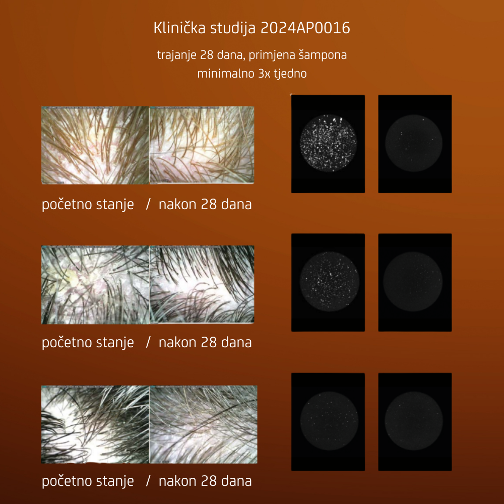 Anti-Dandruff Šampon